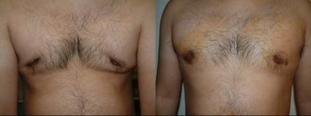 Post Gynecomastia, areolar deformity