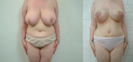 Breast Lift & Tummy Tuck