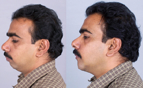 Chin Augmentation