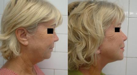 Face and Neck Lift