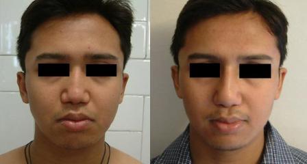 Flat nose-treated by augmentation