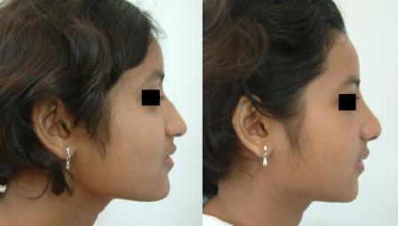 Hump Nose reduction & raising of tip of nose