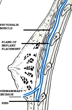 Sub-Pectoral Placement