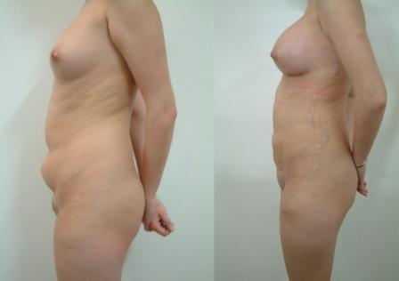Liposuction Abdomen & Breast augmentation