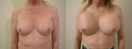 Massive Breast Augmentation-on an unusual request