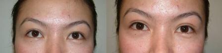 Oriental eyelids correction