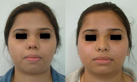 Rhinoplasty-2