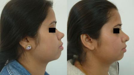 Rhinoplasty