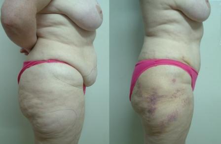 Tummy Tuck & Liposuction of Thighs-profile