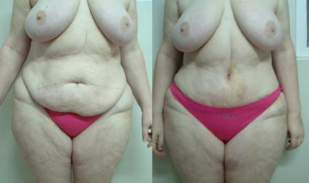 Tummy Tuck-front