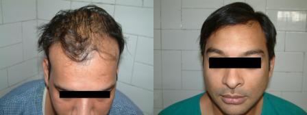 hair transplantation